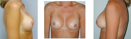 breast augmentation progression 1 month post op