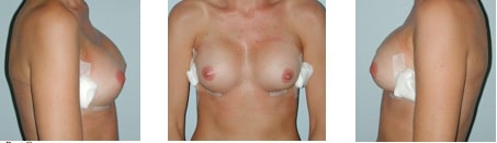 breast augmentation progression 2 days post op
