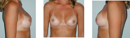 breast augmentation progression 6 months post op