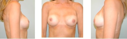 breast augmentation progression 9 years post op