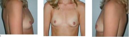 breast augmentation progression before