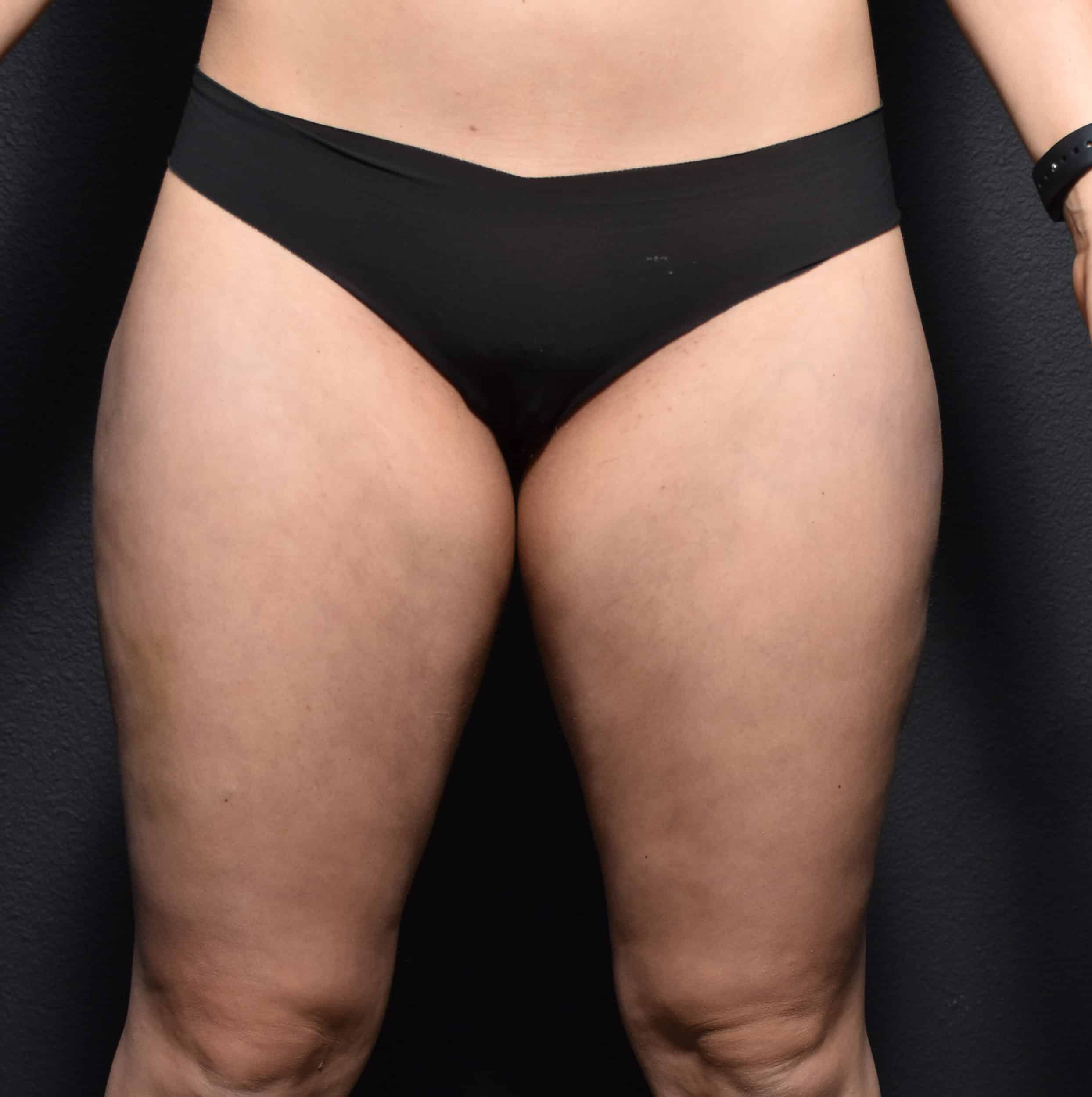 Outer Thigh Liposuction