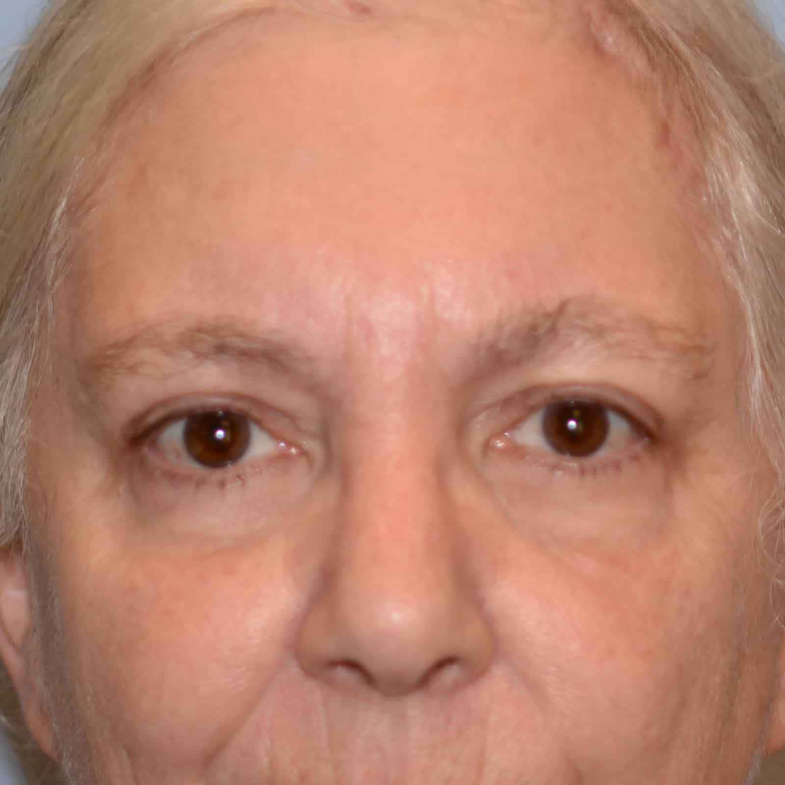 Upper Blepharoplasty and Brow Lift