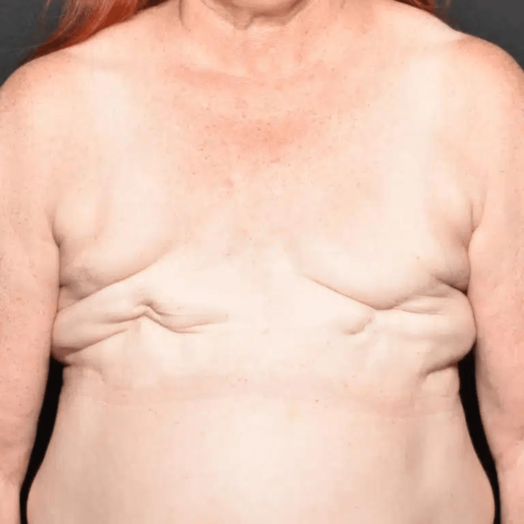Surgeons repair woman's 'crooked breasts' following a double mastectomy