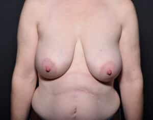 Lumpectomy with Breast Reduction