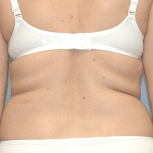 Before Image: Liposuction