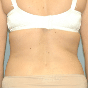 After Image: Liposuction