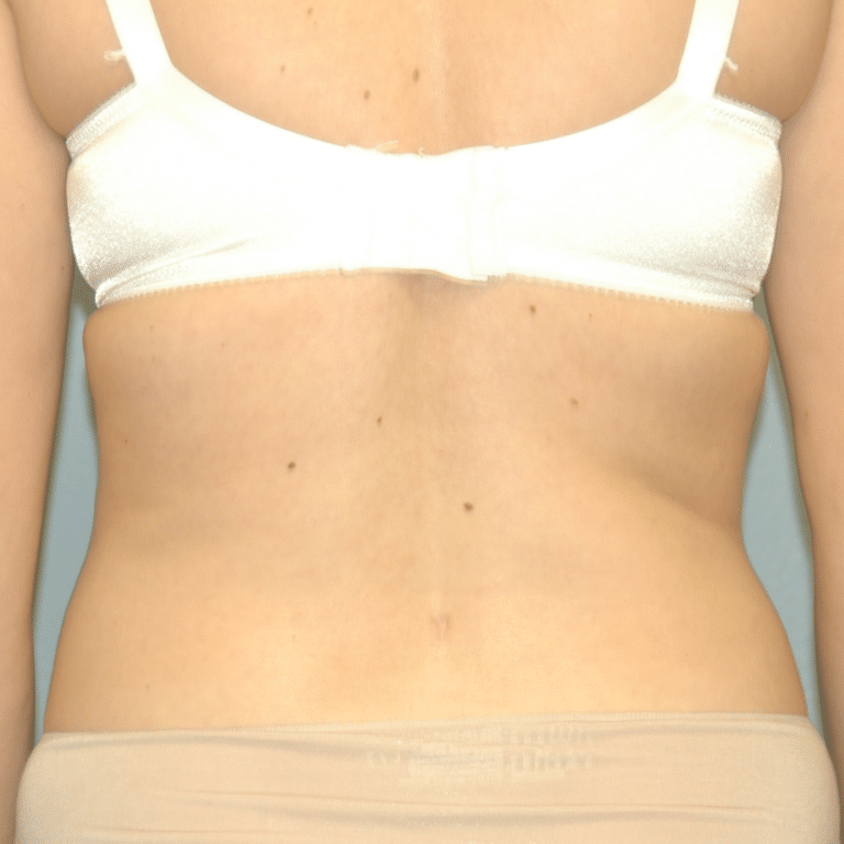 After Image: Liposuction - back