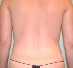 After Image: Liposuction