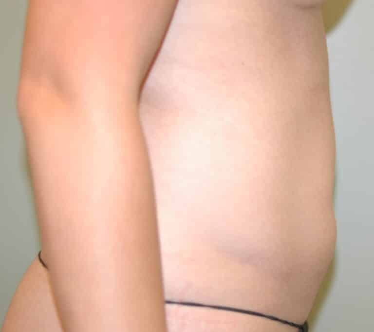 Before Image: Liposuction - right-side