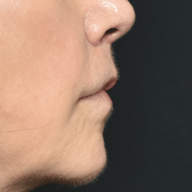 After Image: Lip Lift - right-side