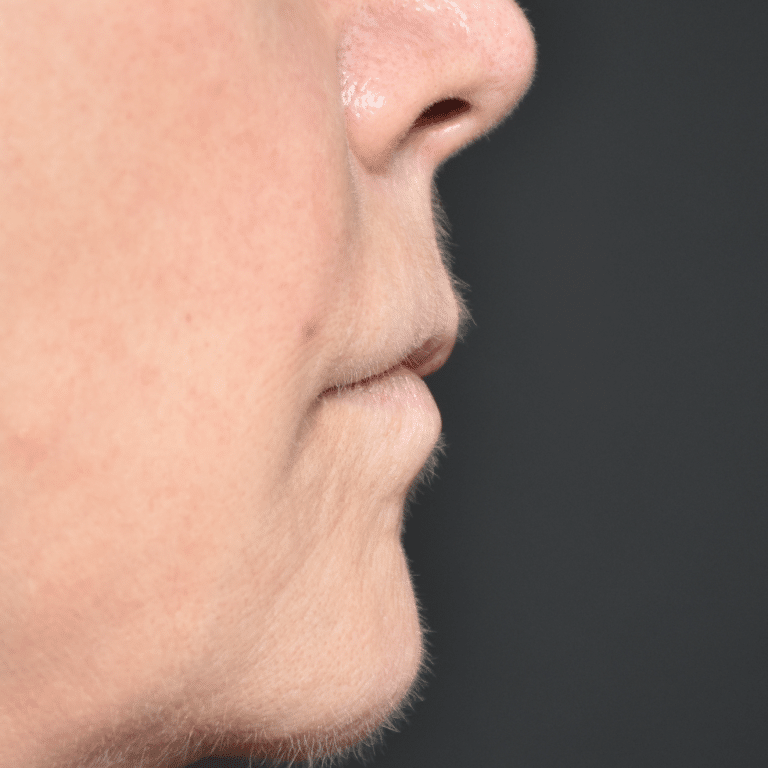 Before Image: Lip Lift - right-side