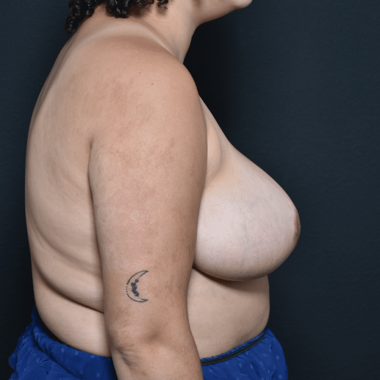 After Image: Breast Reduction - right-side