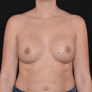 After Image: Breast Augmentation