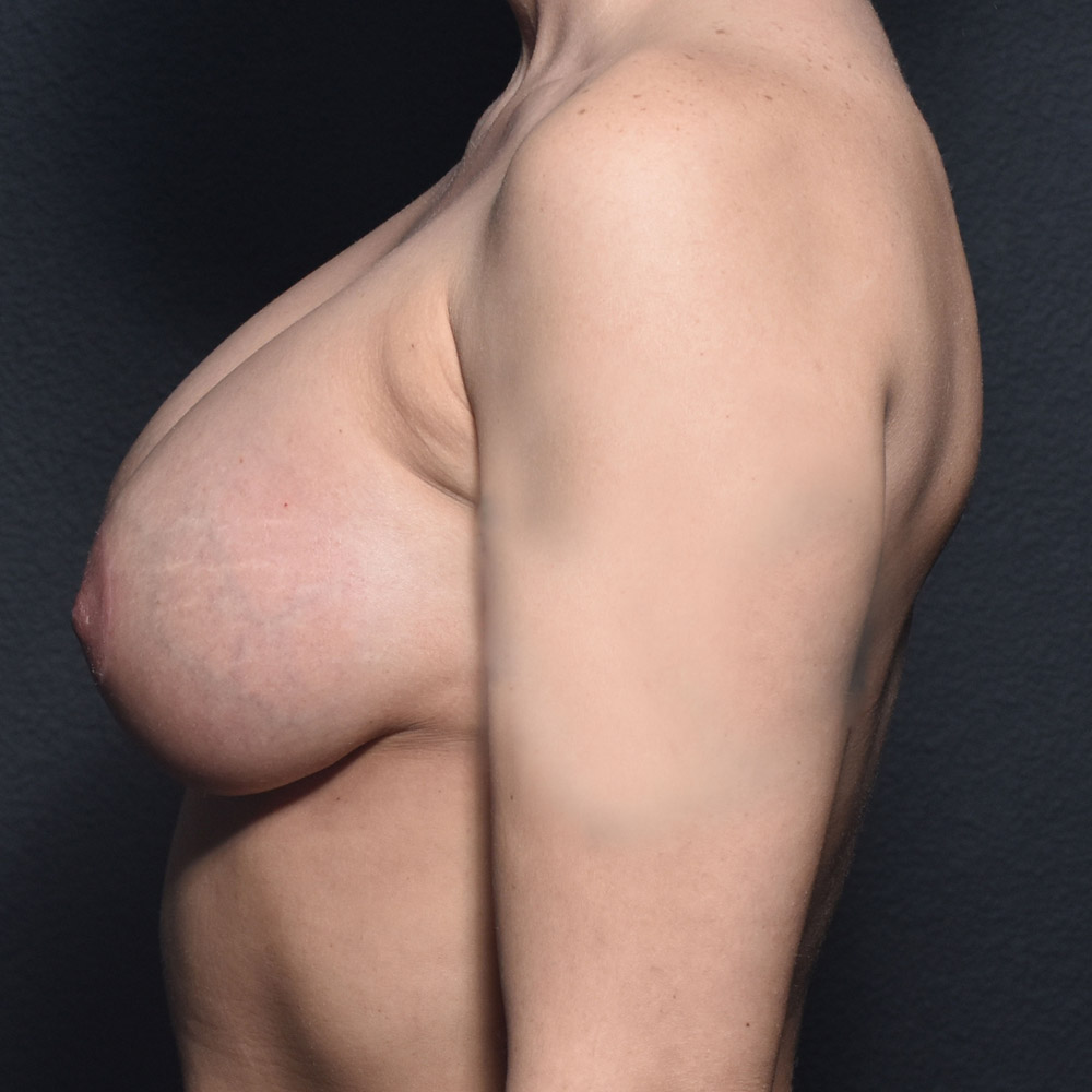 Case--2024 | After Breast Augmentation with Lift 2