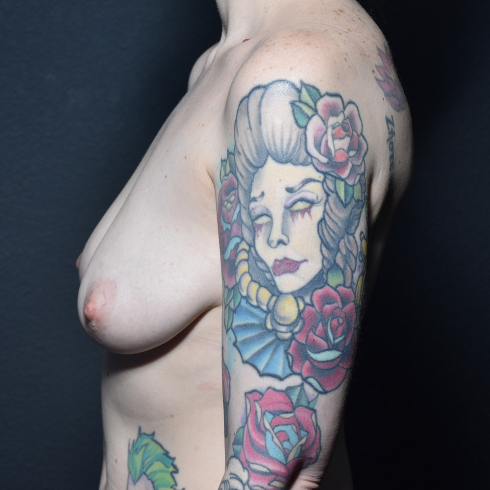 Case--2026 | Before Breast Augmentation with Lift 2