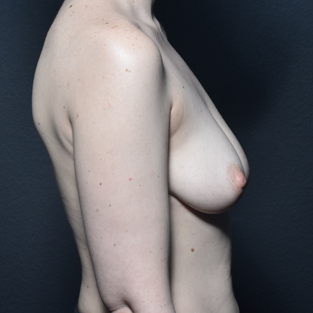 Case--2026 | Before Breast Augmentation with Lift 4