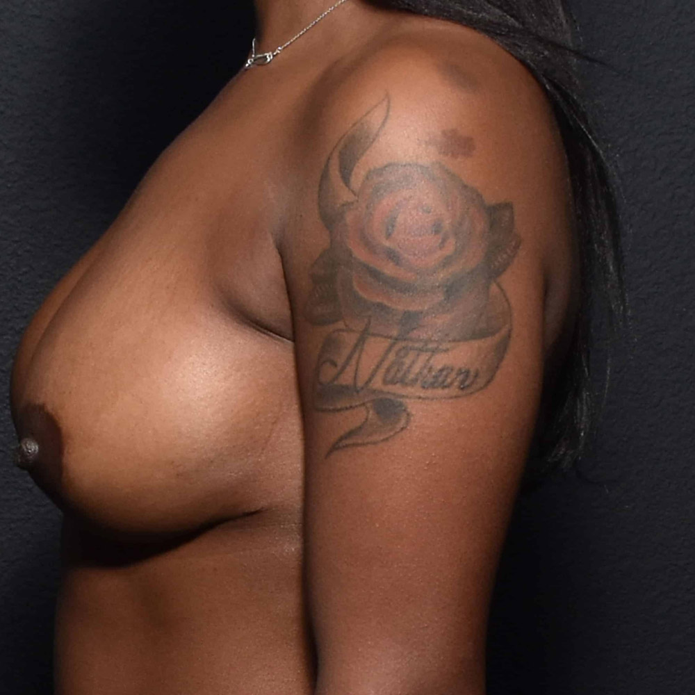 Case--2029 | After Breast Augmentation with Lift 2