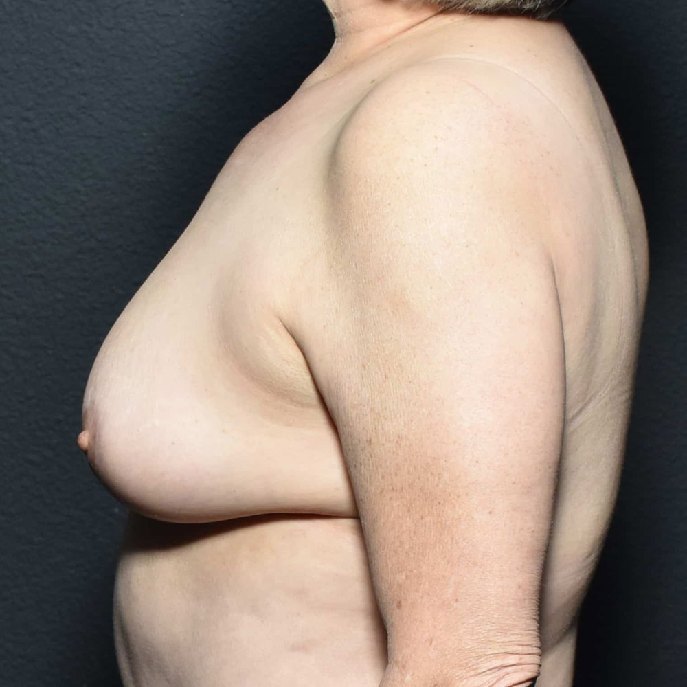 Case--2037 | After Breast Reduction 2