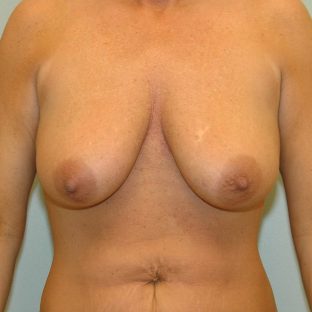 Case--2038 | Before Breast Lift