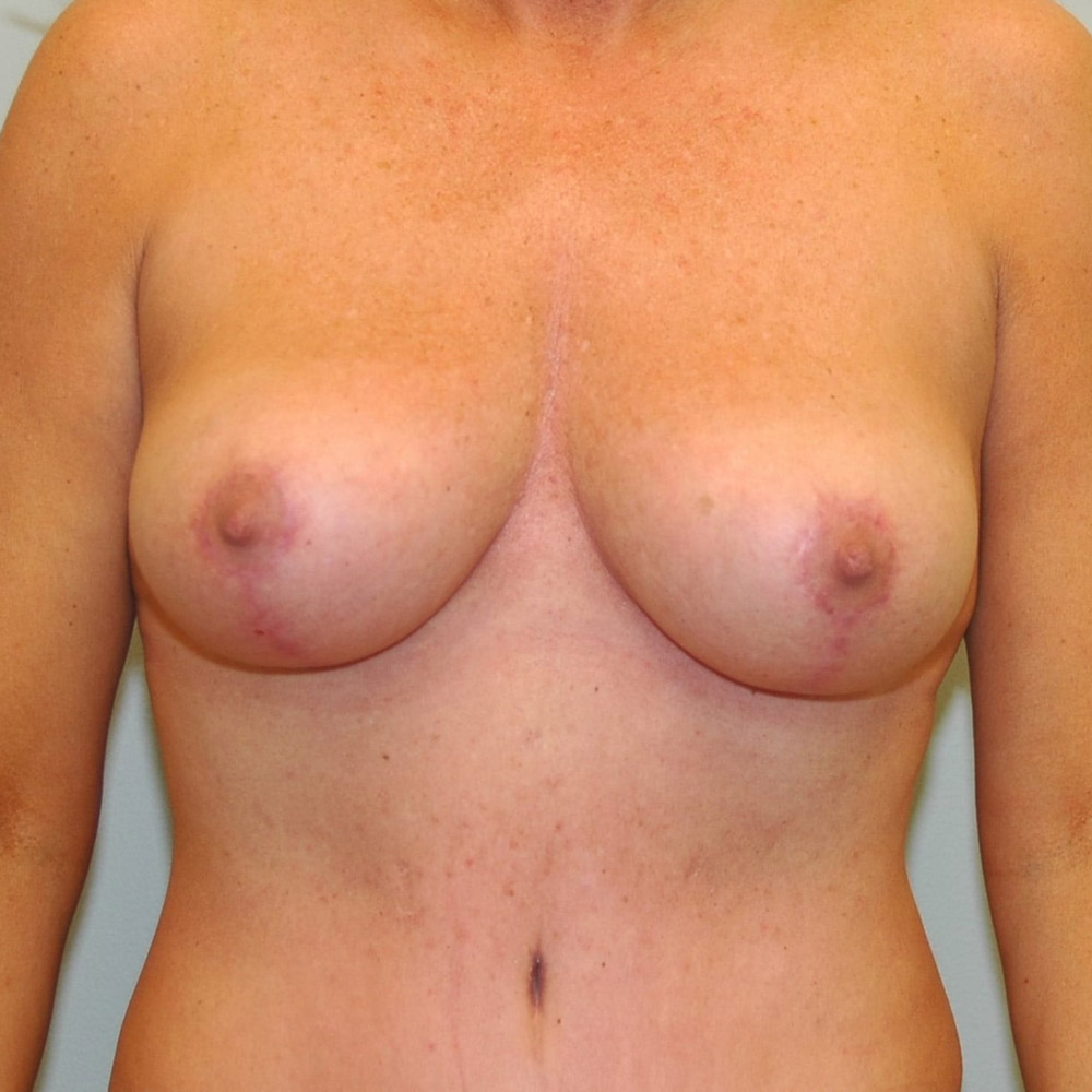 Case--2038 | After Breast Lift