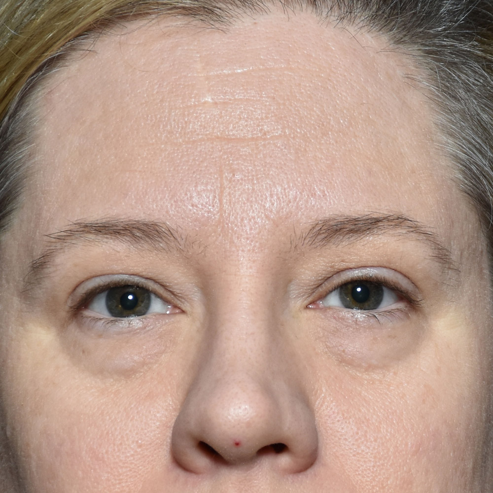 11060 Before Blepharoplasty - Lake Oswego and Portland, Oregon
