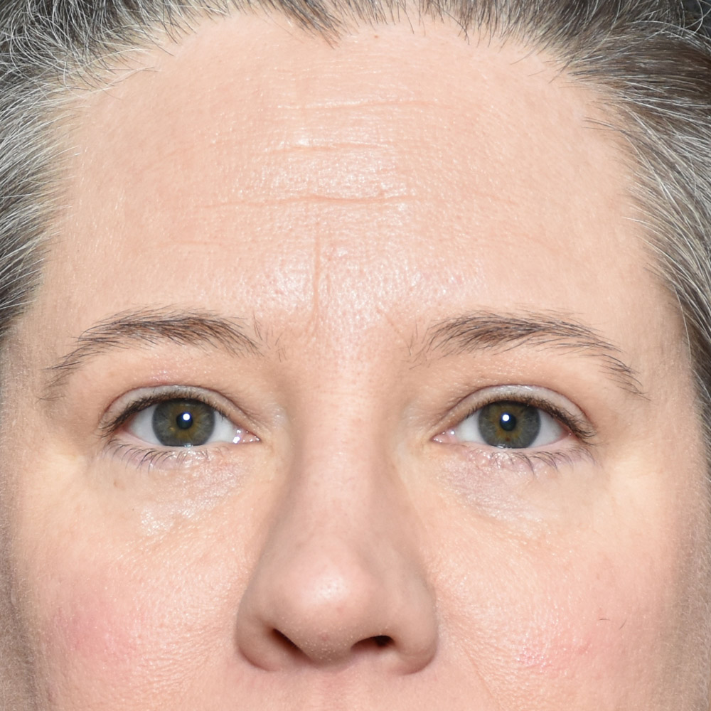 11060 After Blepharoplasty - Lake Oswego and Portland, Oregon