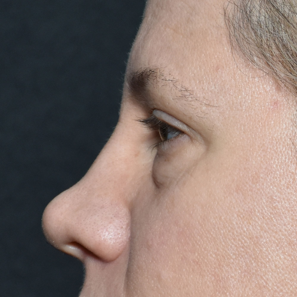 11060 Before Blepharoplasty - Lake Oswego and Portland, Oregon