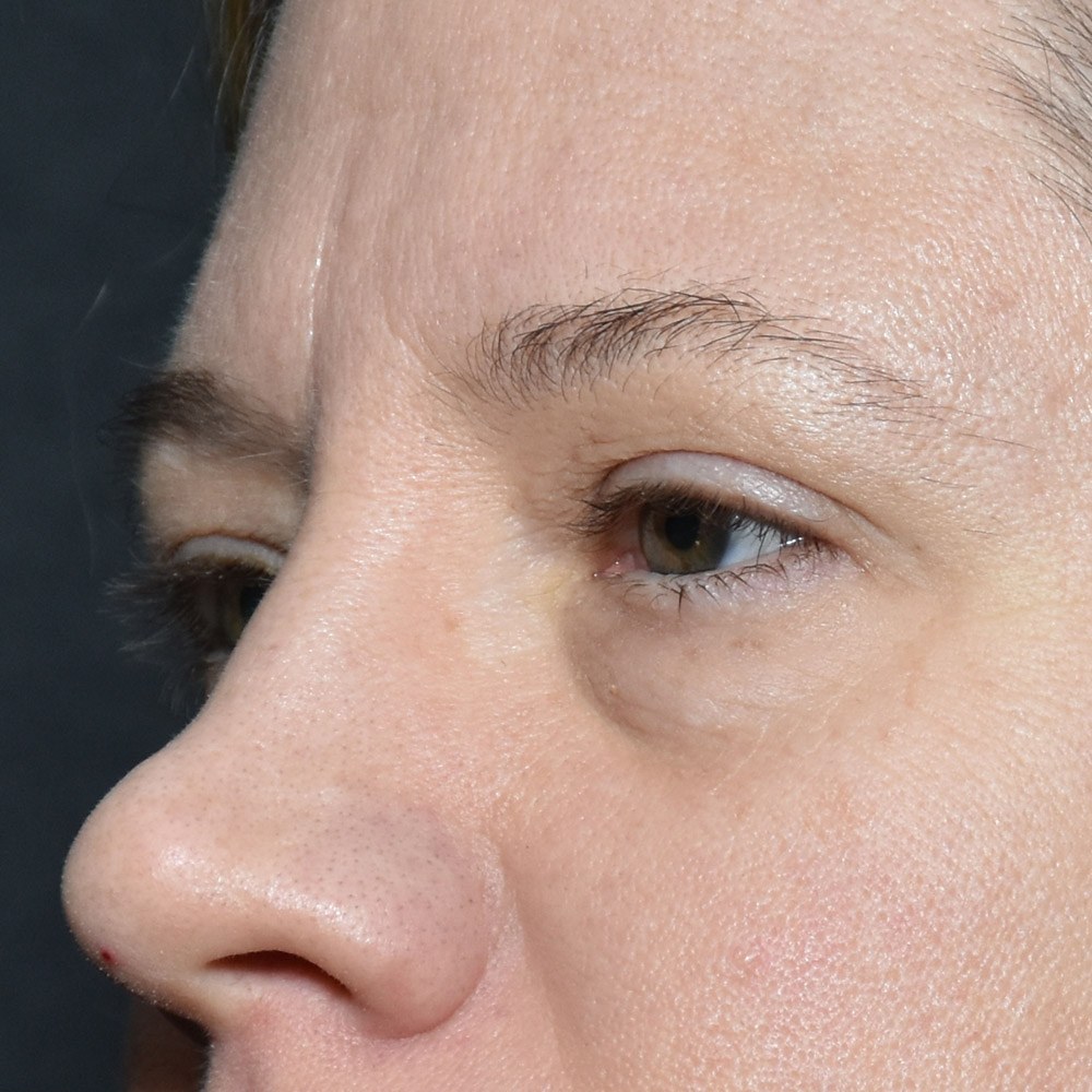 11060 Before Blepharoplasty - Lake Oswego and Portland, Oregon