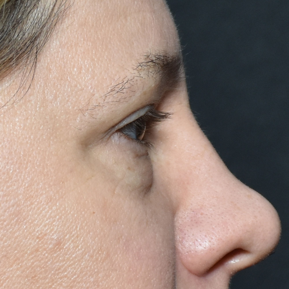 11060 Before Blepharoplasty - Lake Oswego and Portland, Oregon
