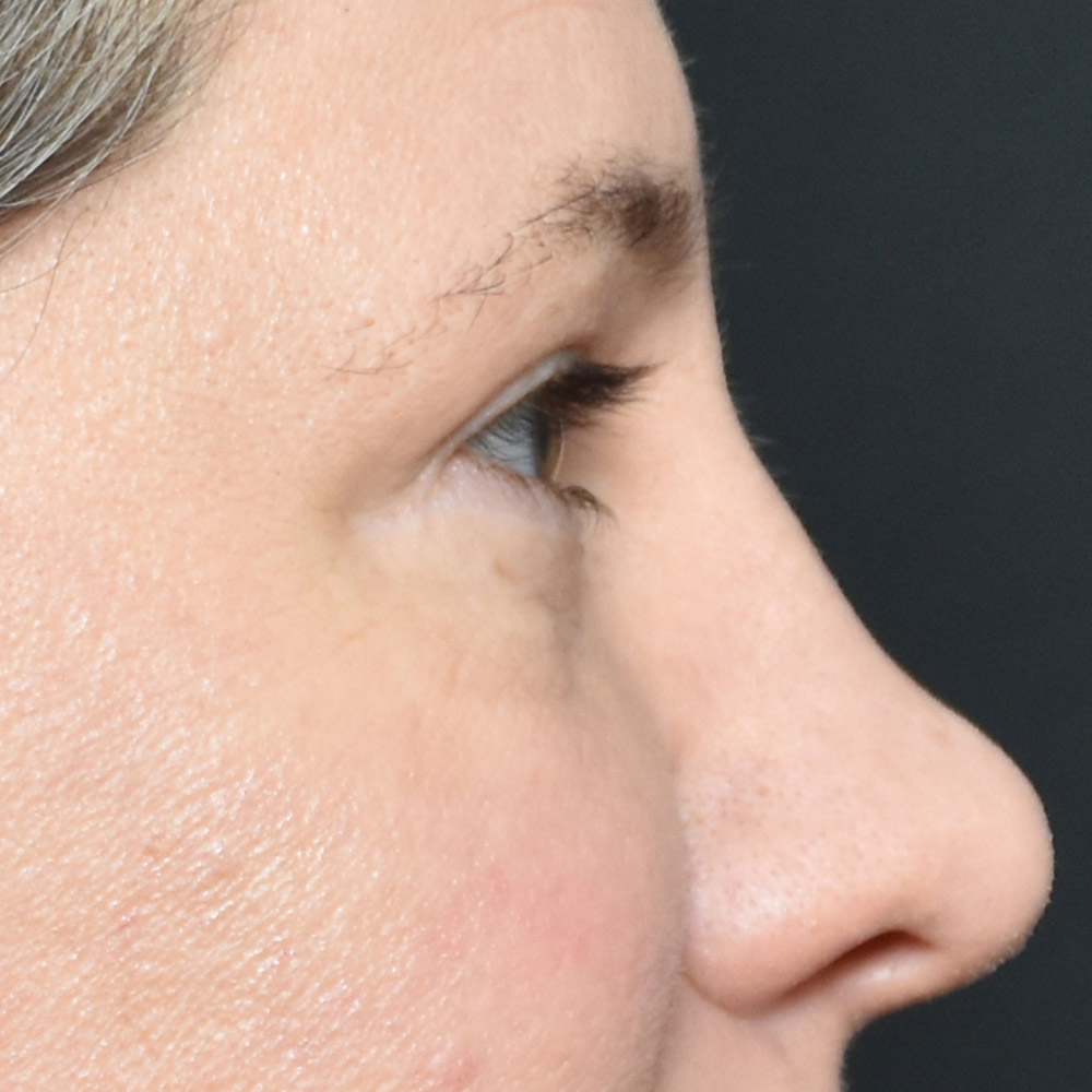 11060 After Blepharoplasty - Lake Oswego and Portland, Oregon
