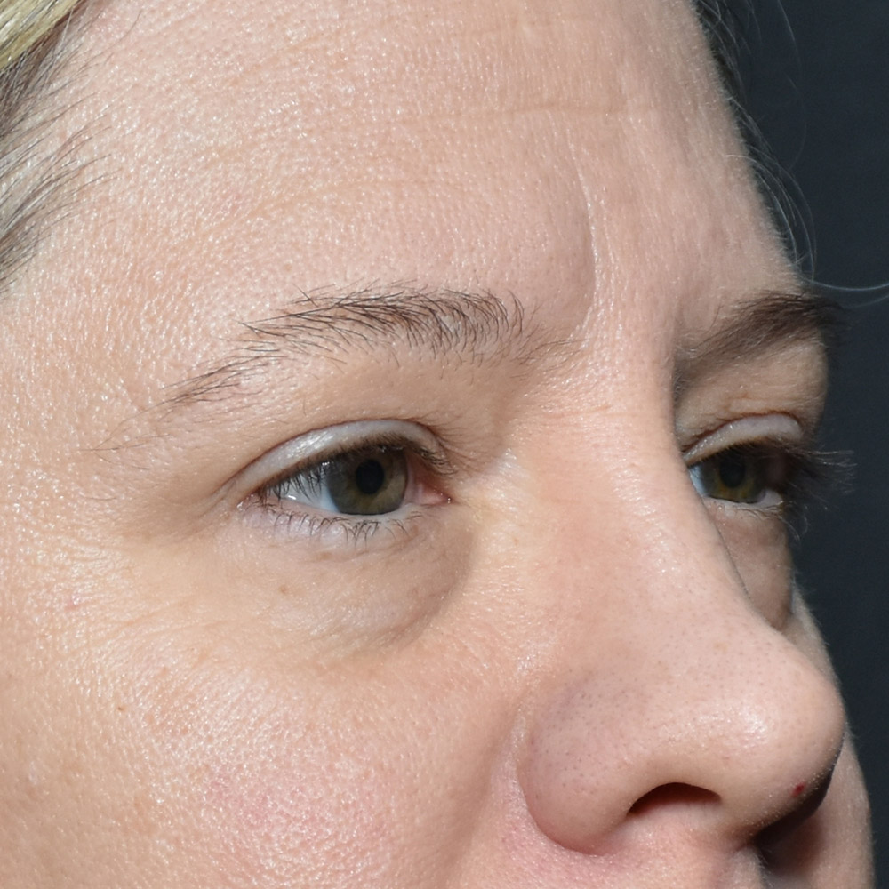 11060 Before Blepharoplasty - Lake Oswego and Portland, Oregon