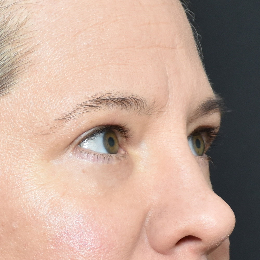 11060 After Blepharoplasty - Lake Oswego and Portland, Oregon