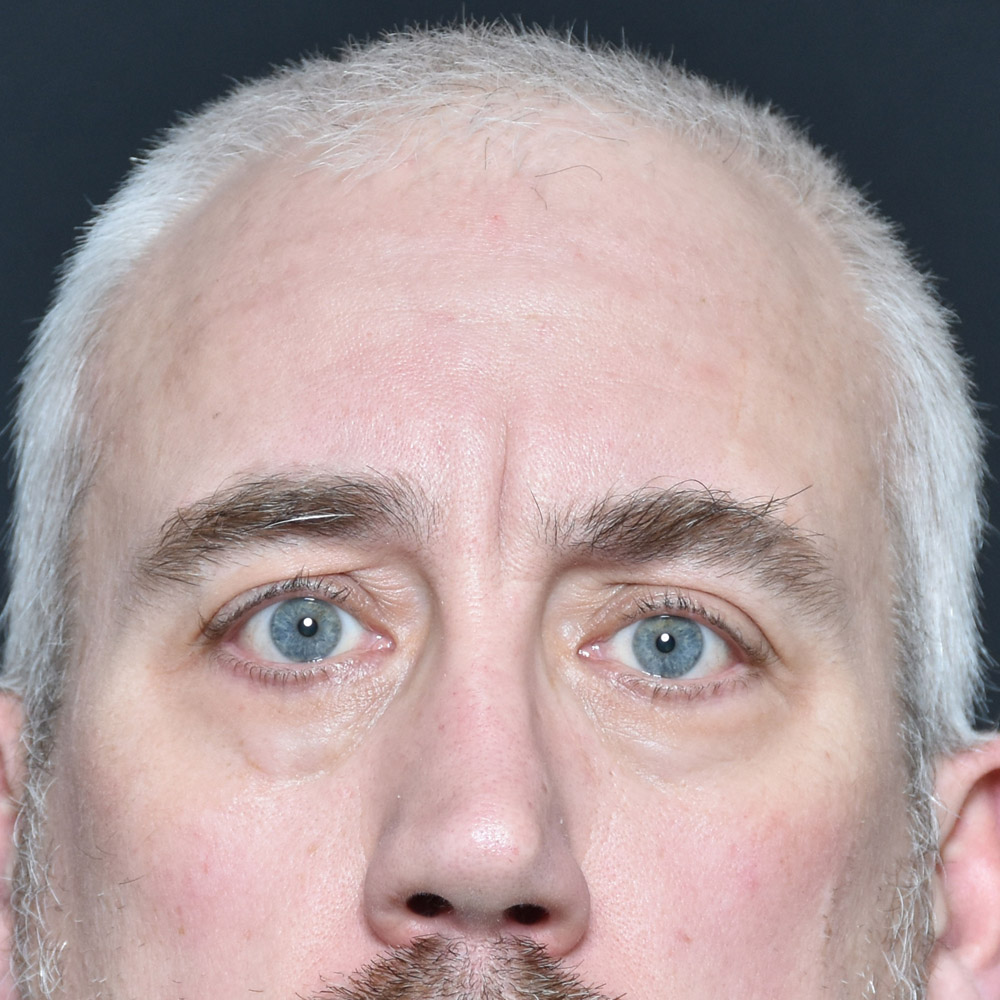 11504 Before Blepharoplasty - Lake Oswego and Portland, Oregon