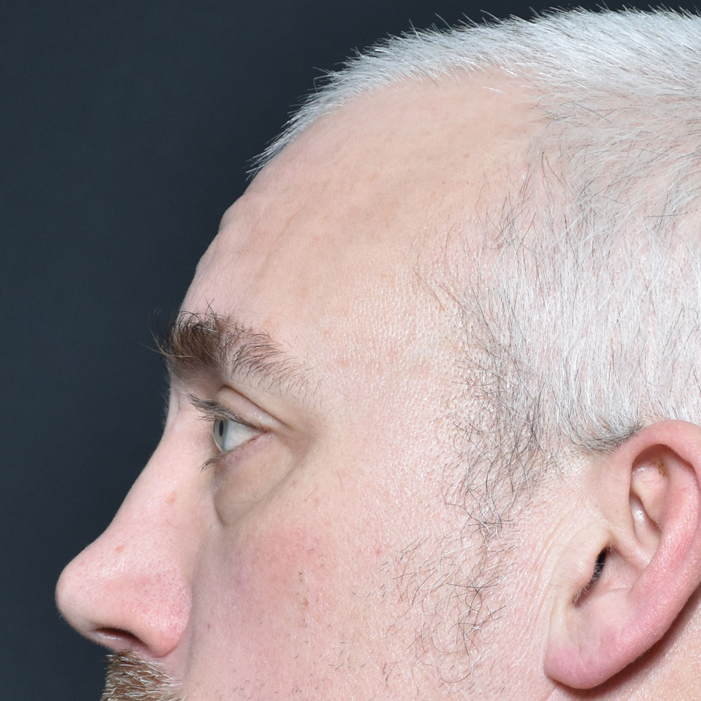 11504 Before Blepharoplasty - Lake Oswego and Portland, Oregon