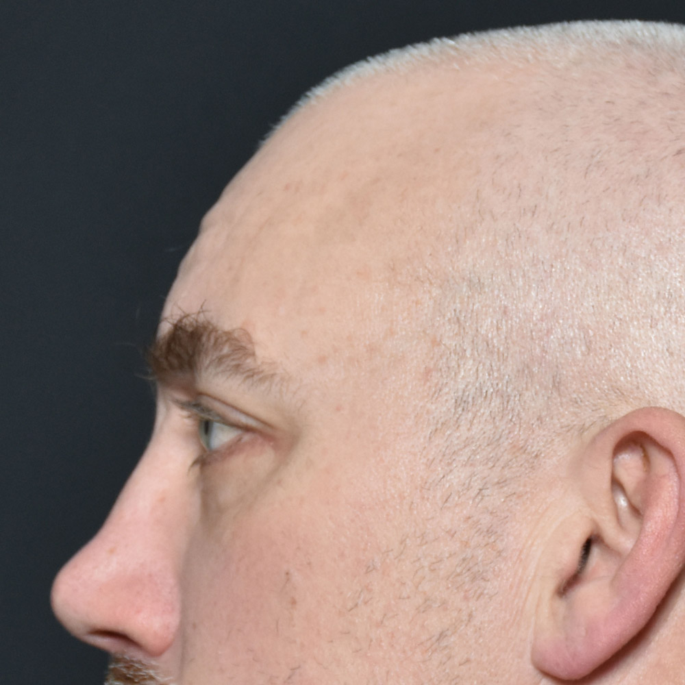 11504 After Blepharoplasty - Lake Oswego and Portland, Oregon