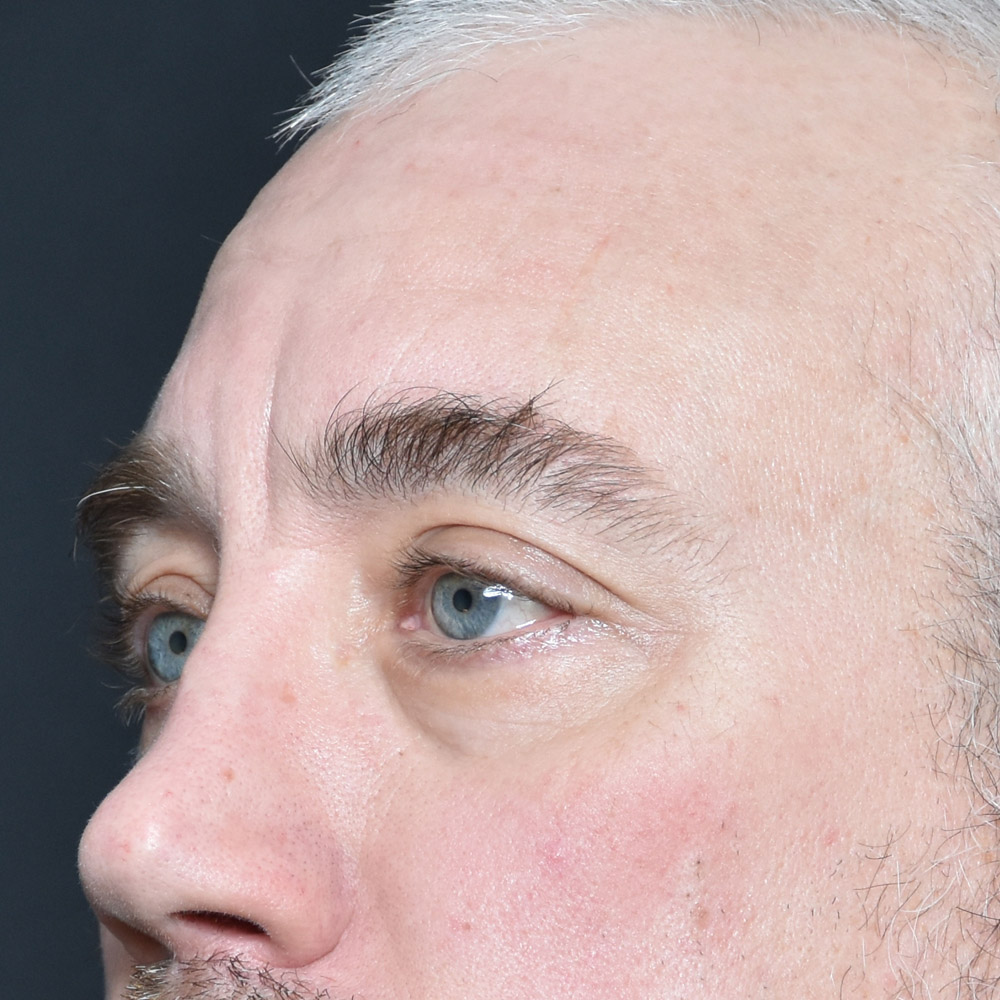 11504 Before Blepharoplasty - Lake Oswego and Portland, Oregon