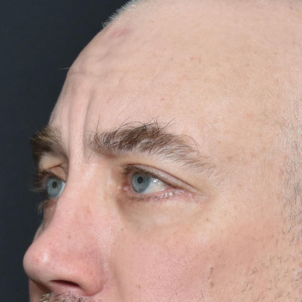 11504 After Blepharoplasty - Lake Oswego and Portland, Oregon