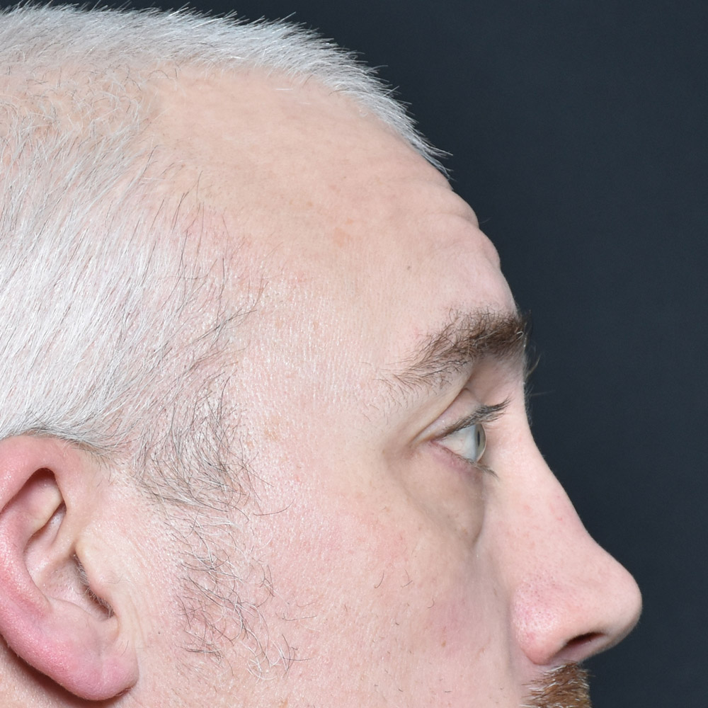 11504 Before Blepharoplasty - Lake Oswego and Portland, Oregon