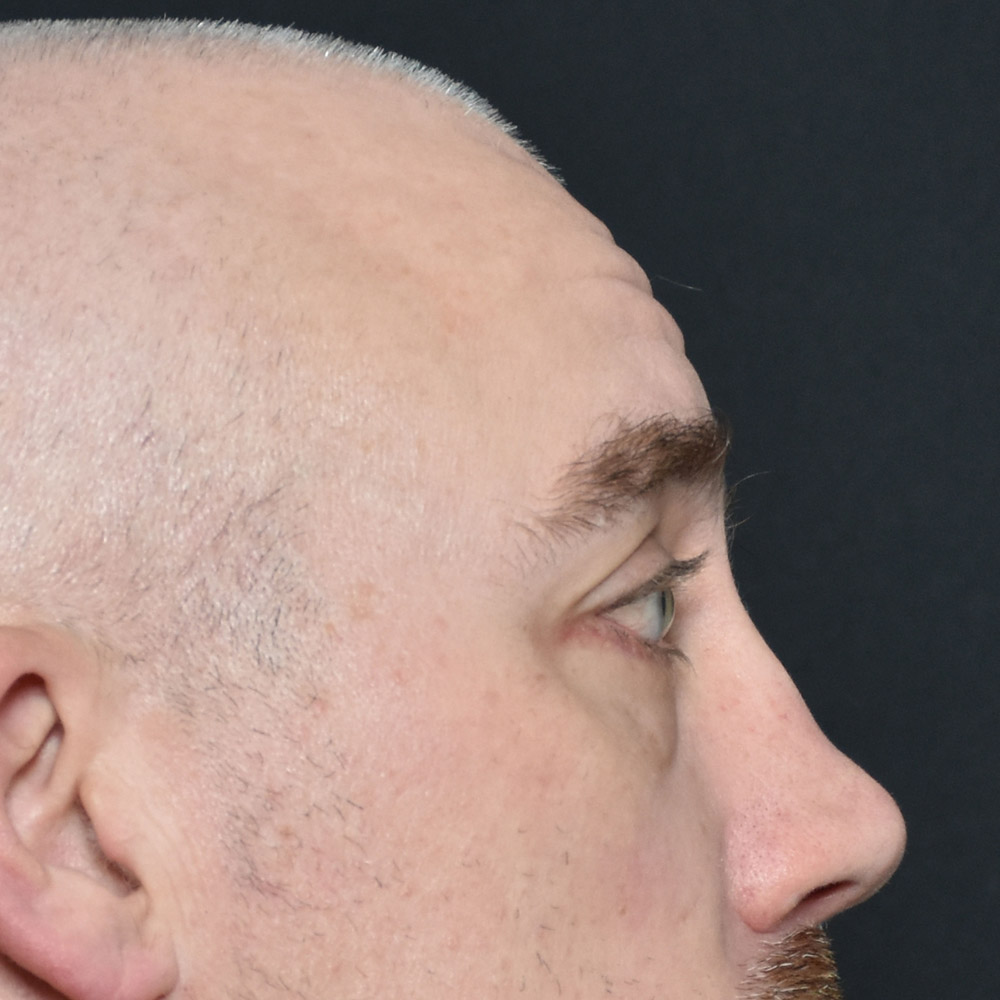 11504 AFter Blepharoplasty - Lake Oswego and Portland, Oregon