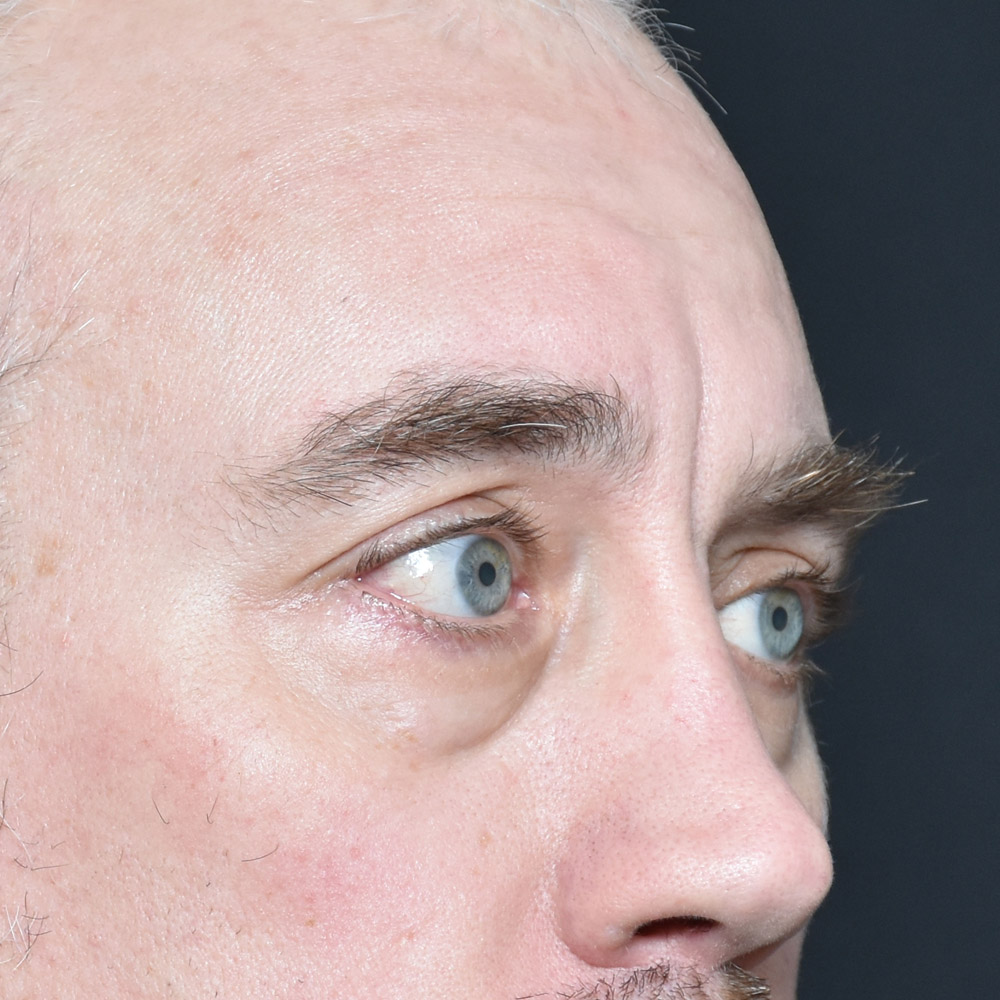 11504 Before Blepharoplasty - Lake Oswego and Portland, Oregon