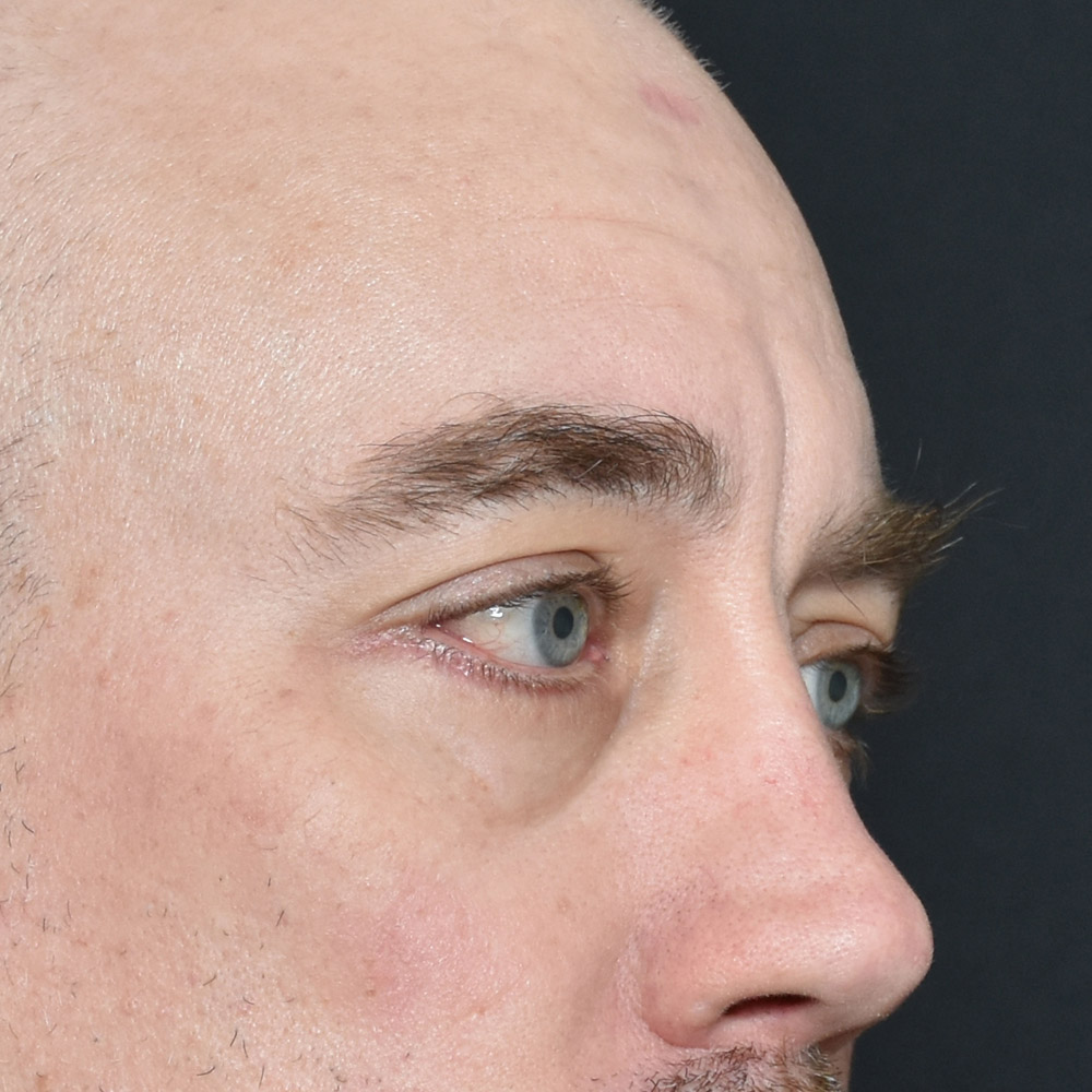 11504 After Blepharoplasty - Lake Oswego and Portland, Oregon