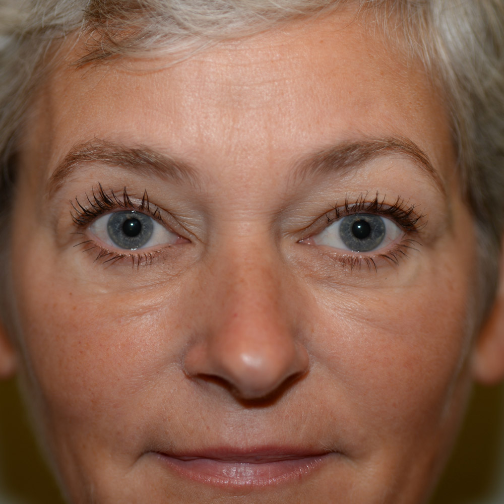 6246 Before Blepharoplasty - Lake Oswego and Portland, Oregon