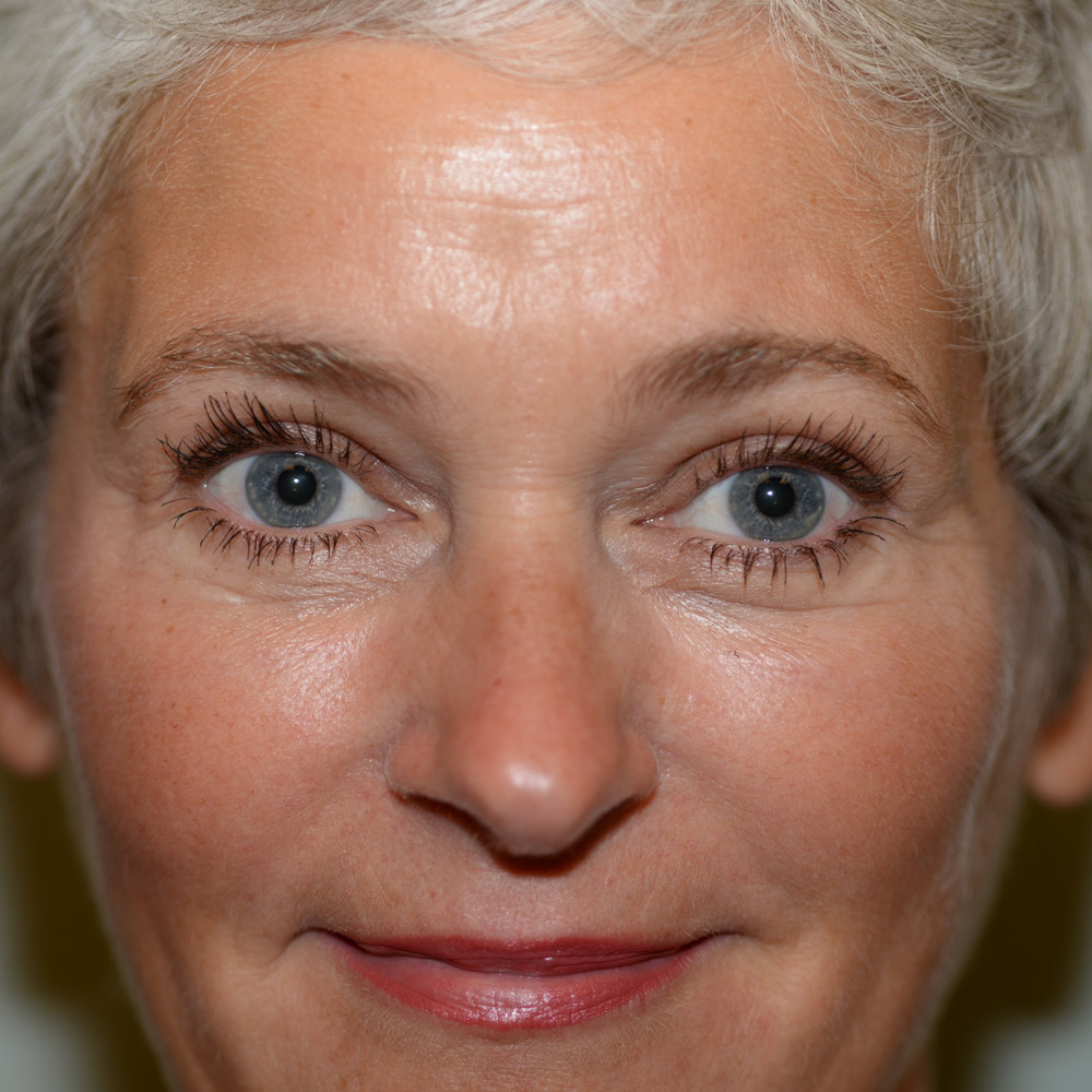6246 After Blepharoplasty - Lake Oswego and Portland, Oregon