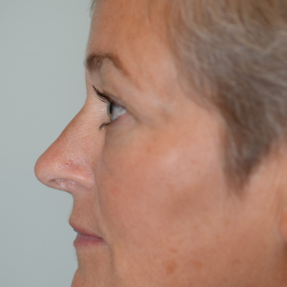 6246 Before Blepharoplasty - Lake Oswego and Portland, Oregon