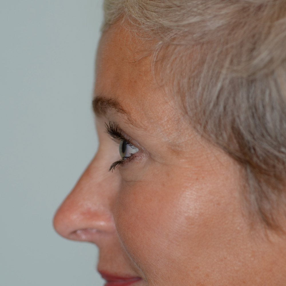 6246 After Blepharoplasty - Lake Oswego and Portland, Oregon