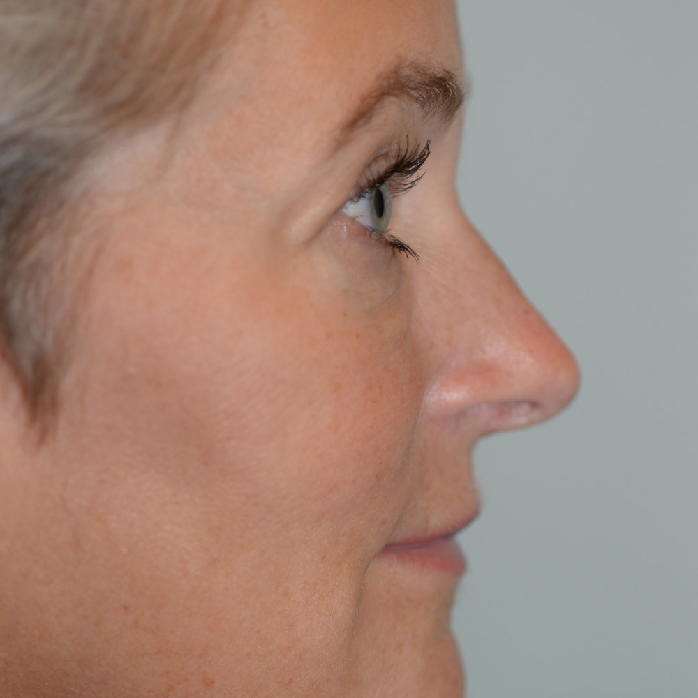 6246 Before Blepharoplasty - Lake Oswego and Portland, Oregon