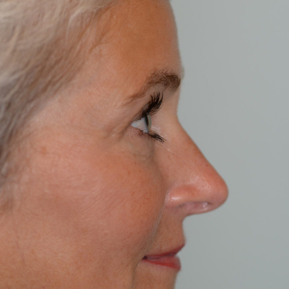 6246 After Blepharoplasty - Lake Oswego and Portland, Oregon