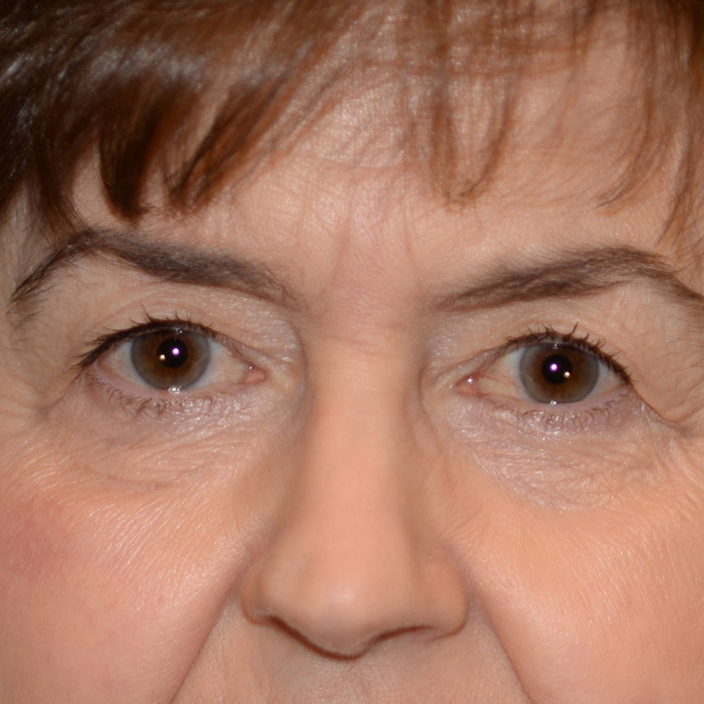 6328 Before Blepharoplasty - Lake Oswego and Portland, Oregon