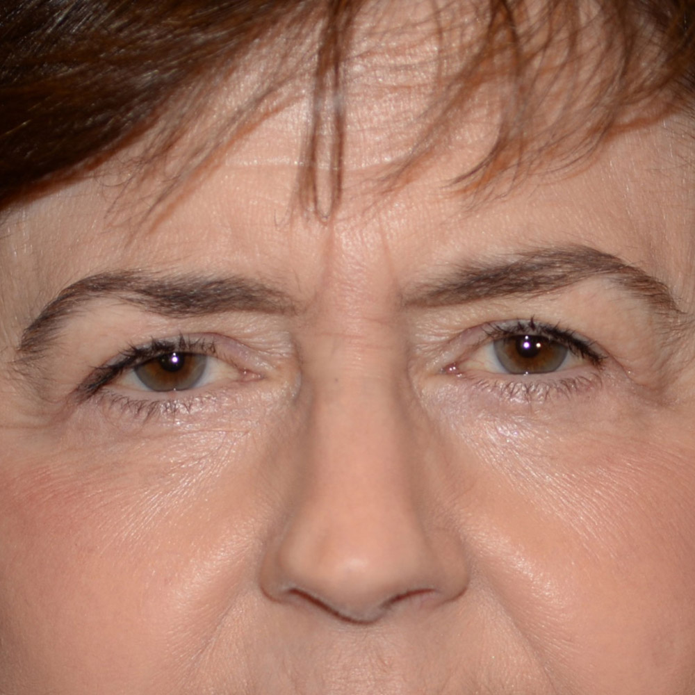 6328 After Blepharoplasty - Lake Oswego and Portland, Oregon